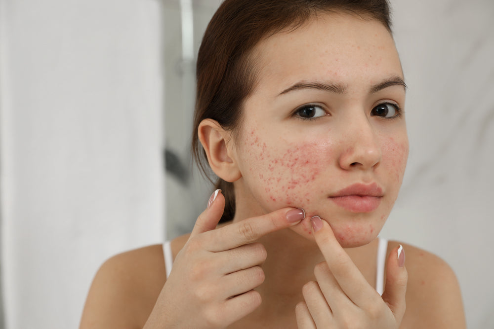 Does Stress Cause Acne?