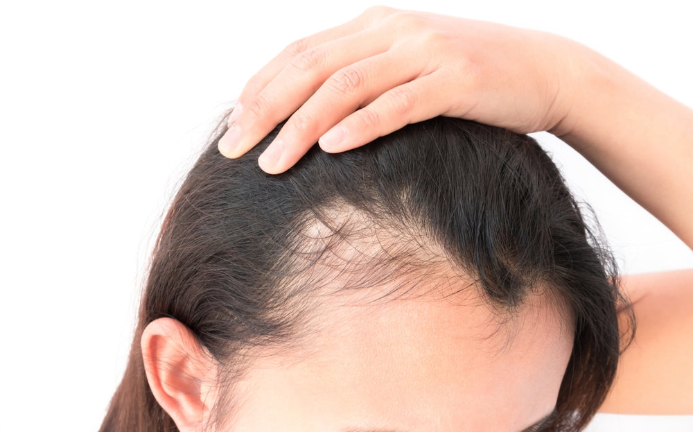 Can Anxiety Cause Hair Loss?